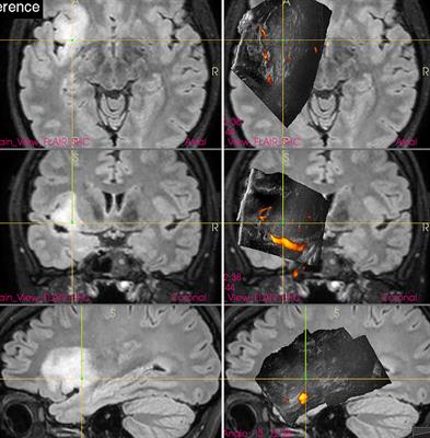 Current Limitations of Intraoperative Ultrasound in Brain Tumor Surgery